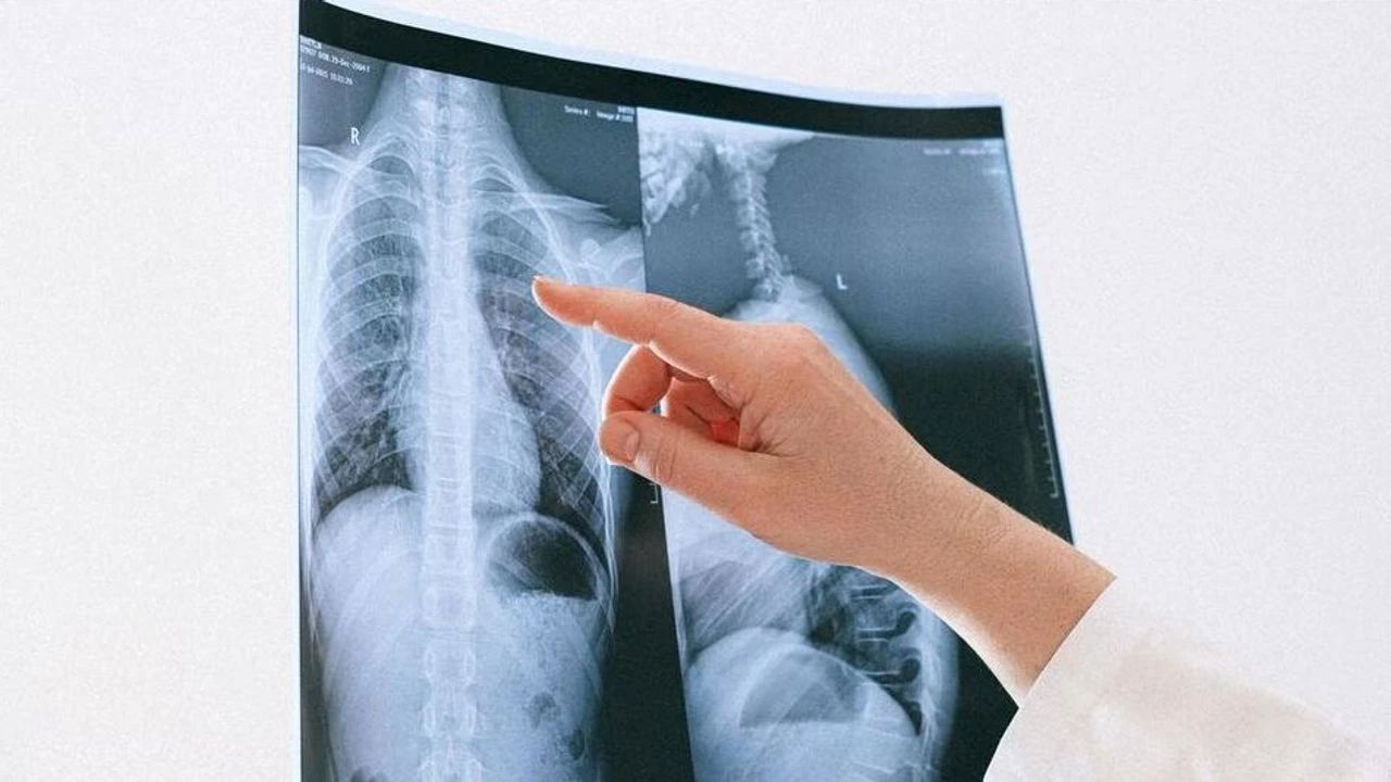 Akciğer Kanseri Her Yıl Milyonlarca Can Alıyor: En Büyük Sebebi Belli