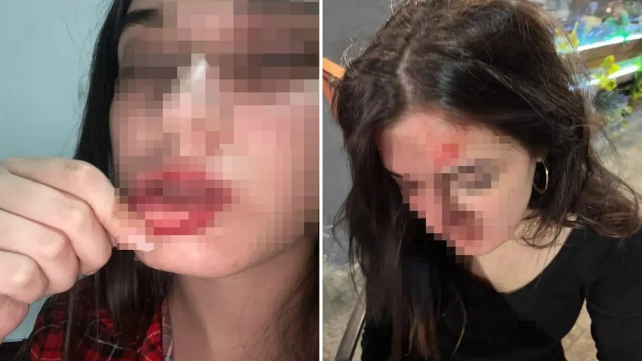 Samsun’da eski sevgili dehşeti: “Beni tuzağa düşürdü” diyen genç kız darp fotoğraflarını paylaştı